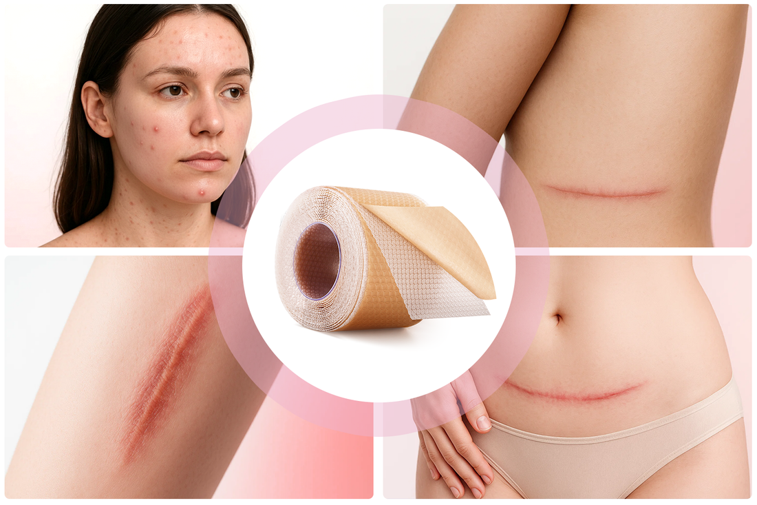 When to Use Silicone Scar Sheets