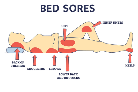 Bed Sores