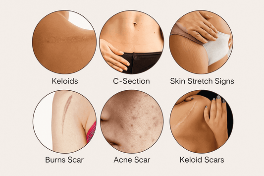 Various scars healed with silicone scar sheets