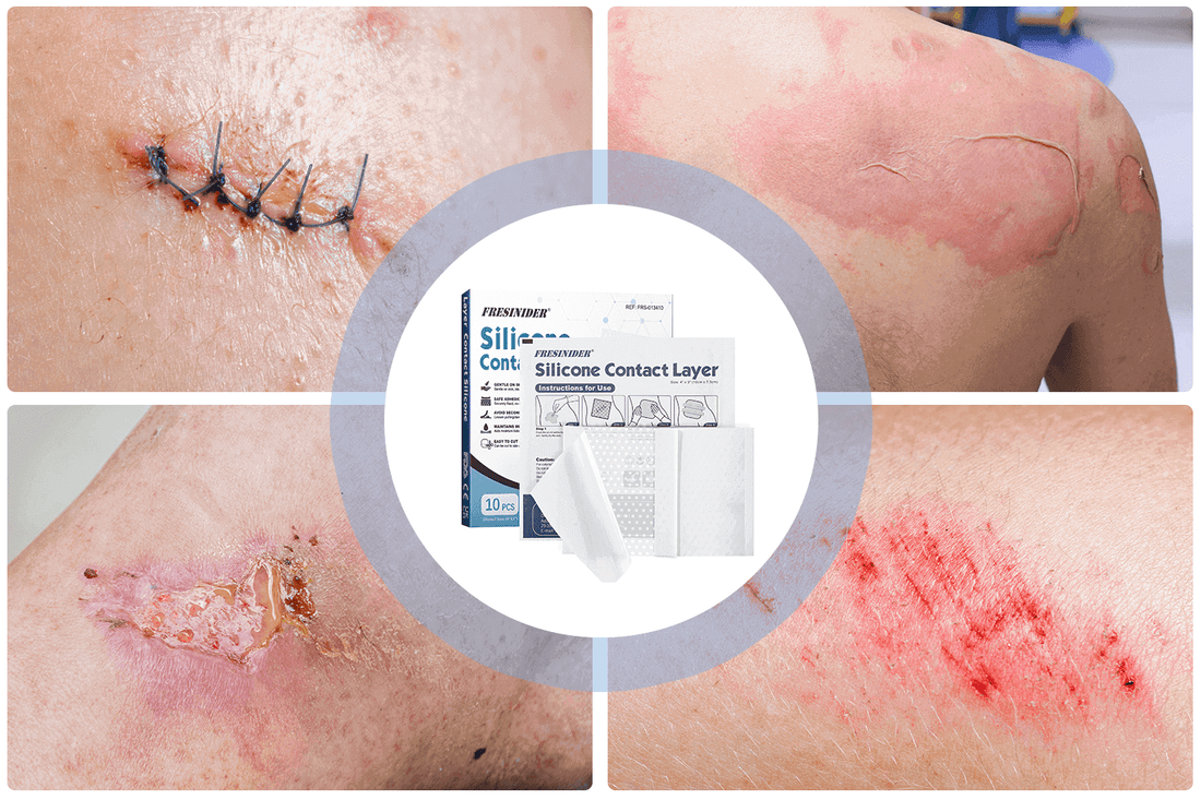 Silicone wound contact layer use cases