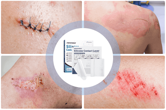 Silicone wound contact layer use cases