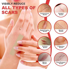 FRESINIDER silicone scar roll sheet for C-section surgery burn trauma and keloid scars