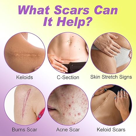 FRESINIDER silicone scar roll sheet for keloid C-section burn and acne scar care