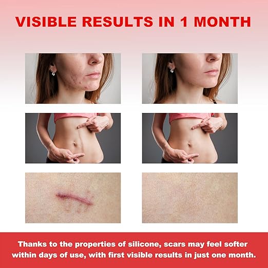 FRESINIDER silicone scar roll sheet before and after results for scar care