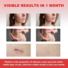 FRESINIDER silicone scar roll sheet before and after results for scar care