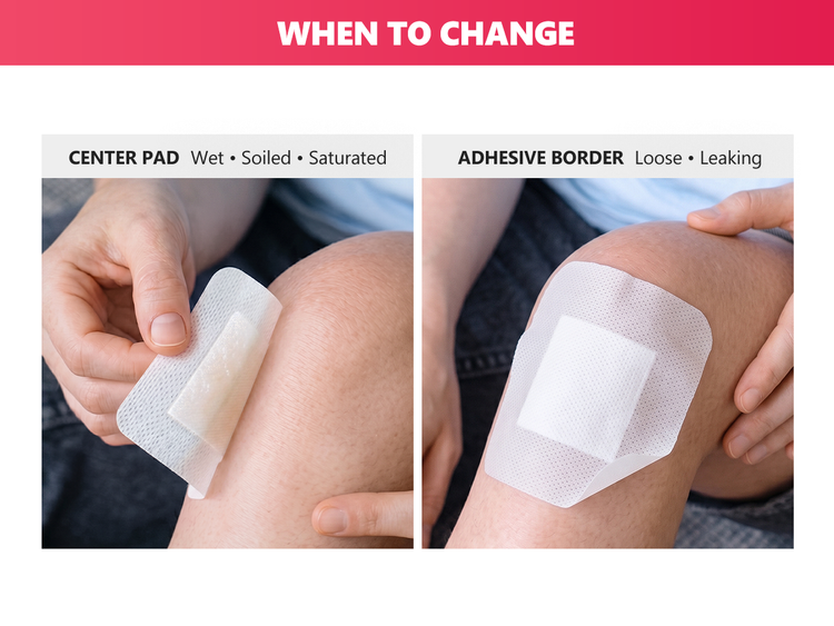 When to change a FRESINIDER island dressing